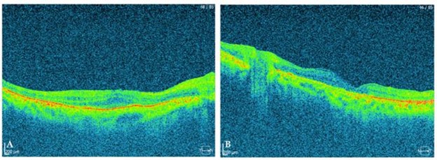 【佳学基因检测】巨额花费肾移植，却得了视网膜纤毛病：基因检测在肾病与眼科共病中的作用